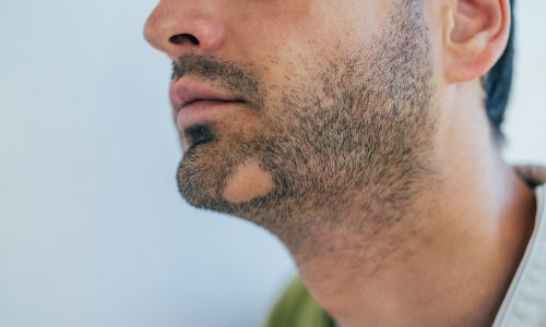Beard & Moustache Transplant