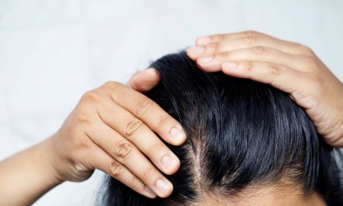 Female Hair Transplant
