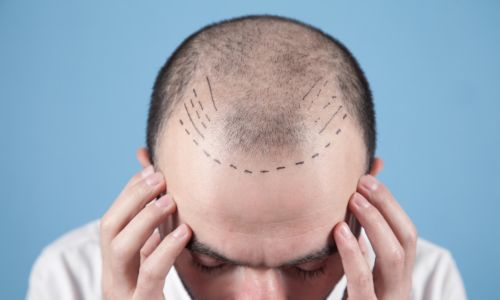 FUE Hair Transplant